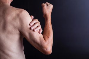 muscle atrophy inflammation